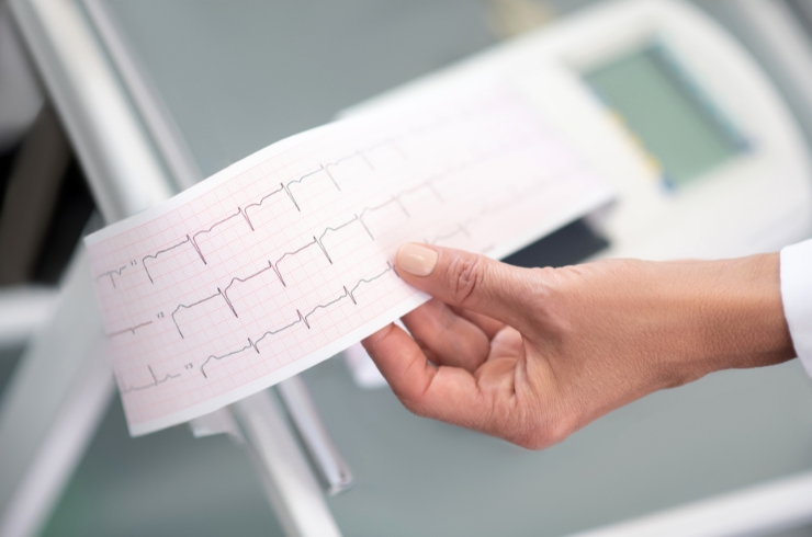 ECG